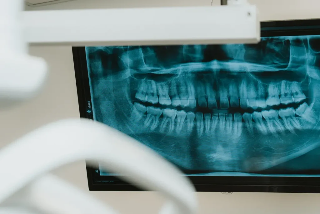 Radiographie panoramique dentaire affichée à l'écran au Centre dentaire Boucherville